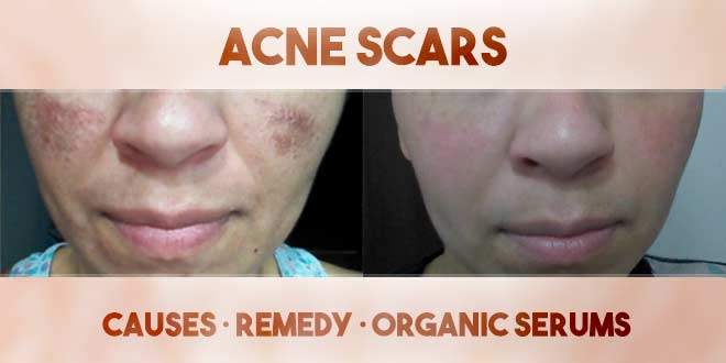 acne_scars_660x330