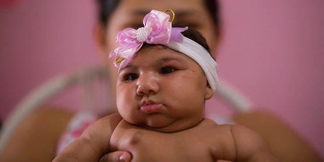 Zika Outbreak – Summary of a Public Health Emergency